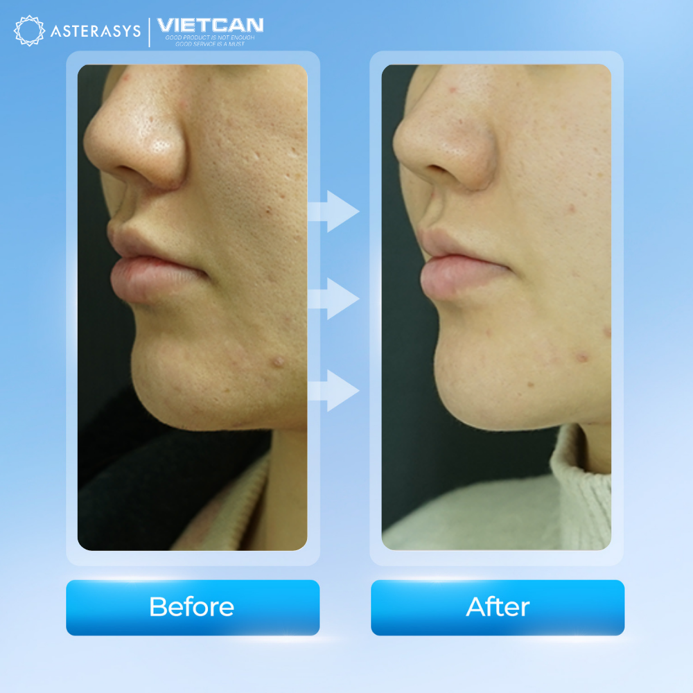 Before/ After của Liftera A2