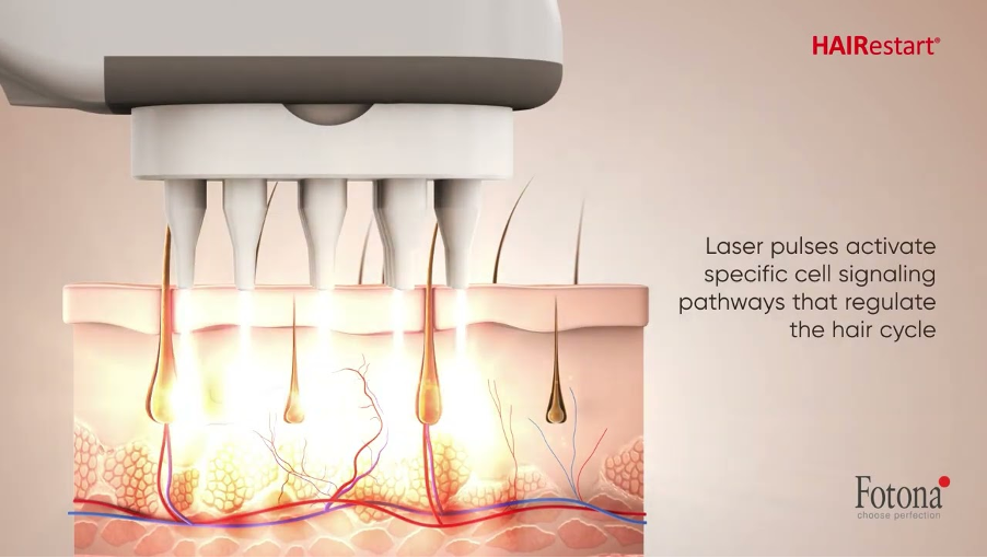 HAIRestart® – Công nghệ laser hỗ trợ điều trị rụng tóc thế hệ mới
