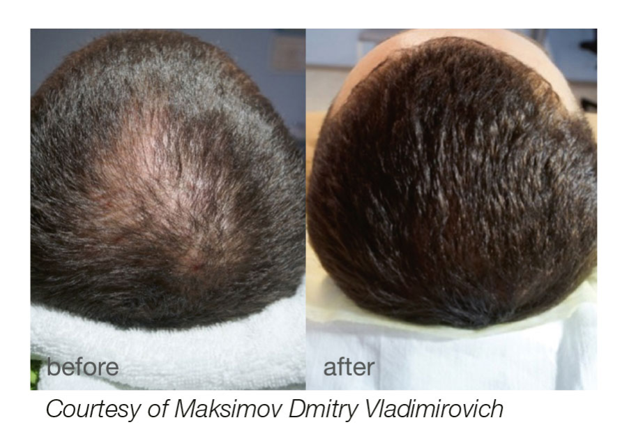 Rụng tóc do nội tiết (Androgenetic Alopecia)