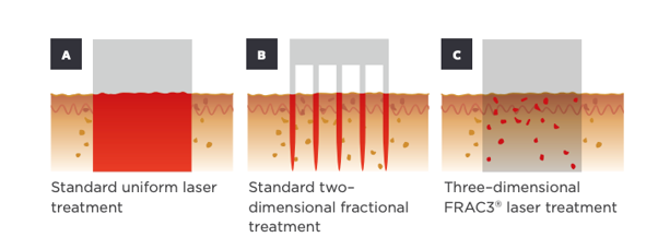 Frac3 Mode (Nd:YAG)