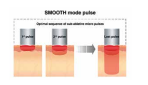Fotona Smooth Mode (Er:YAG)